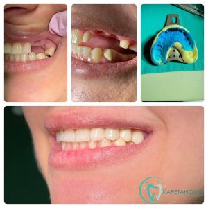 bocni-bezmetalni-keramicki-most