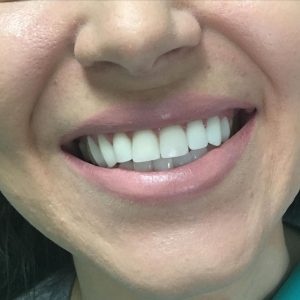 cirkonijum-zubne-krune