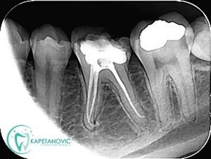 endodoncija