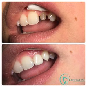 fraktura-cirkonijum-krunica