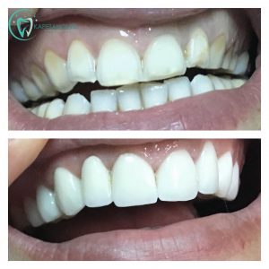 bezmetalne-cirkonijum-krunice