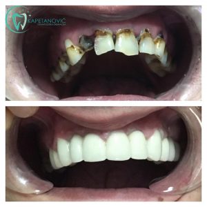 metalokeramicki-most