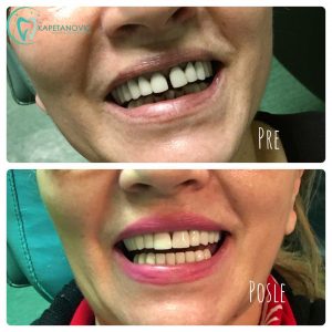 metalokeramicki-most